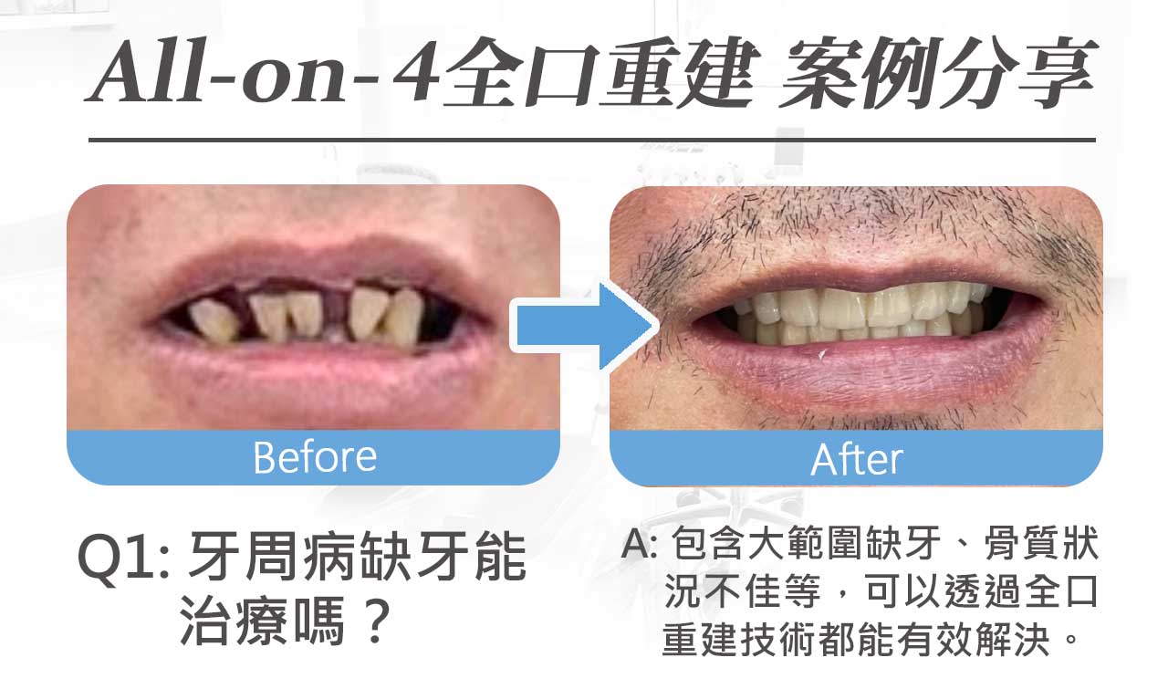 All-on-4案例患者術後開心地笑著